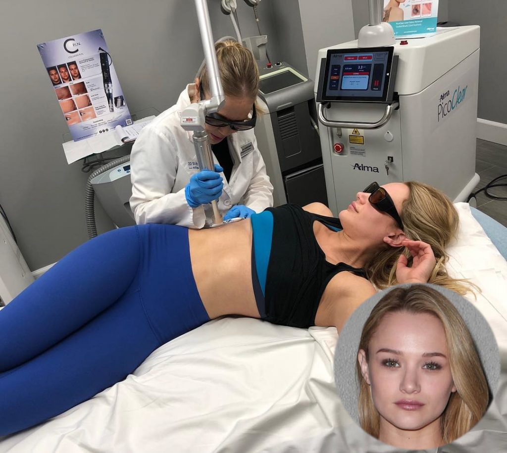 Hunter King Tattoo Laser Removal